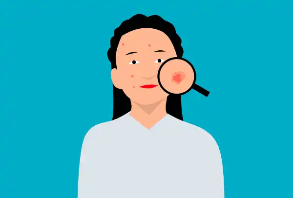 Cara Alami Hilangkan Bekas Jerawat, Aman untuk Kesehatan Kulit